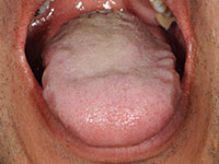 舌圧痕 症例１