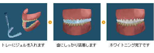 ホームホワイトニング ホームホワイトニング